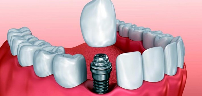 Что такое одномоментная имплантация зубов?